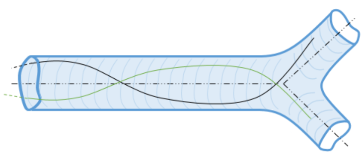 Two potential orientations of the guide wire selecting different paths